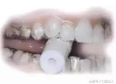 隐形牙套佩戴注意事项,替牙期隐形牙套佩戴管理