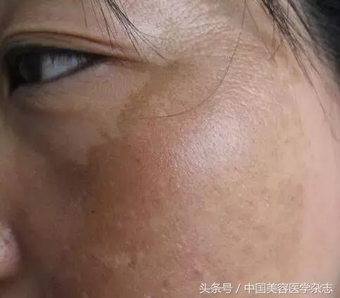 药物水光注射治疗*褐斑黄**对患者CK10、SOD及MDA表达水平的影响