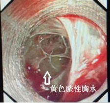 胸水为什么会抽不到,胸水抽了为什么还呼吸困难