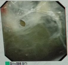 胸水为什么会抽不到,胸水抽了为什么还呼吸困难