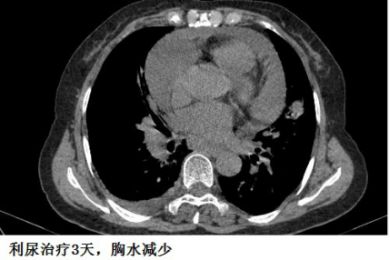 胸水抽了为什么还呼吸困难,胸水抽不出来了怎么回事