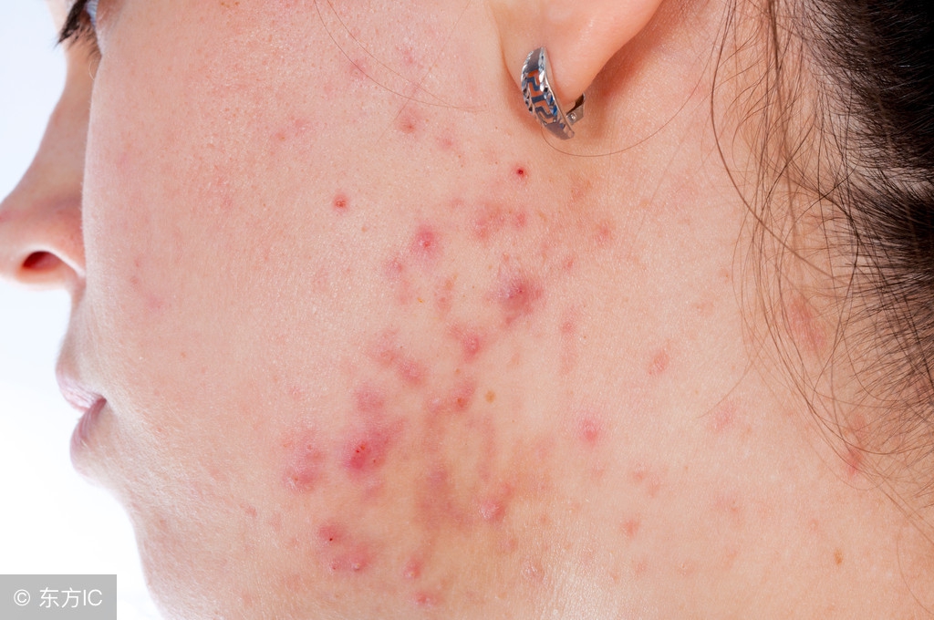 全身频繁长疮是怎么回事,身体多个部位长疮什么原因