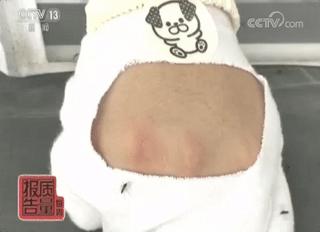 用了防蚊贴过敏,贴了防蚊贴蚊子叮的全是包