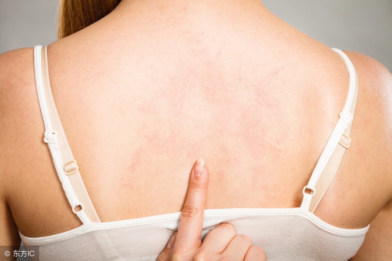 湿疹颜色变深褐色脱皮,手部湿疹脱皮怎么治疗