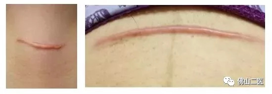 疤痕没那么可怕找对方法即可淡疤,有疤痕的你还在为疤痕烦恼吗