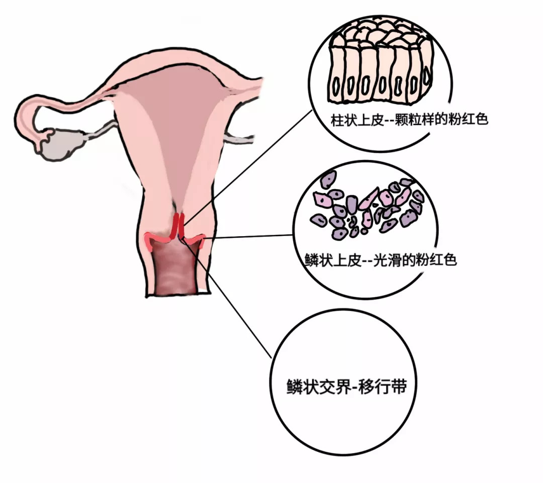女性宫颈糜烂有什么症状和现象,宫颈糜烂用什么药好得快效果好
