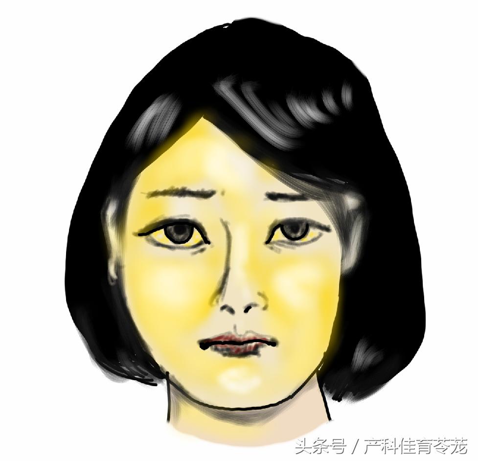 妊娠期总胆汁酸高说明什么影响,妊娠期肝内胆汁酸增高