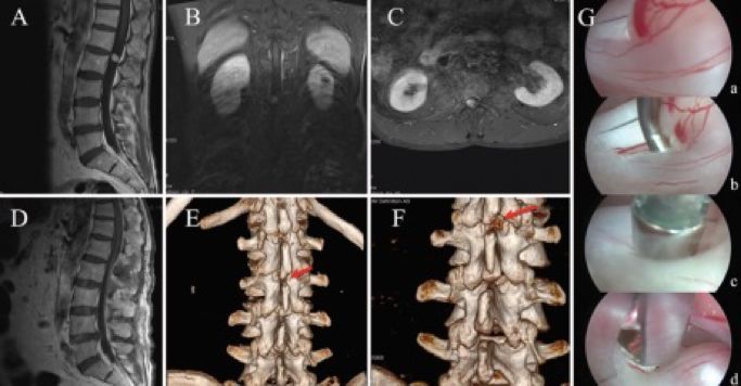 试遍了针灸艾灸拔罐，腰背疼痛的元凶竟是“肿瘤”