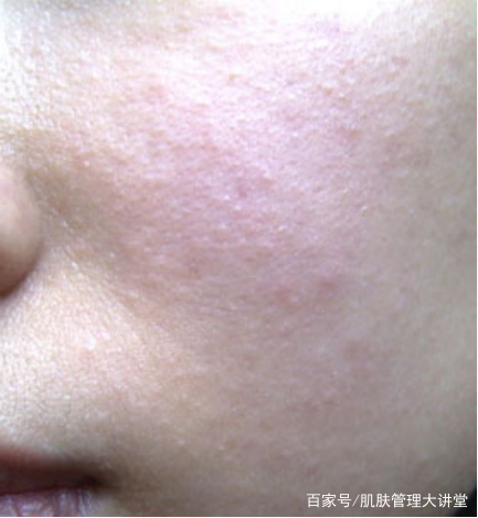 教你如何拒绝长痘痘,怎么样才能摆脱痘痘肌肤