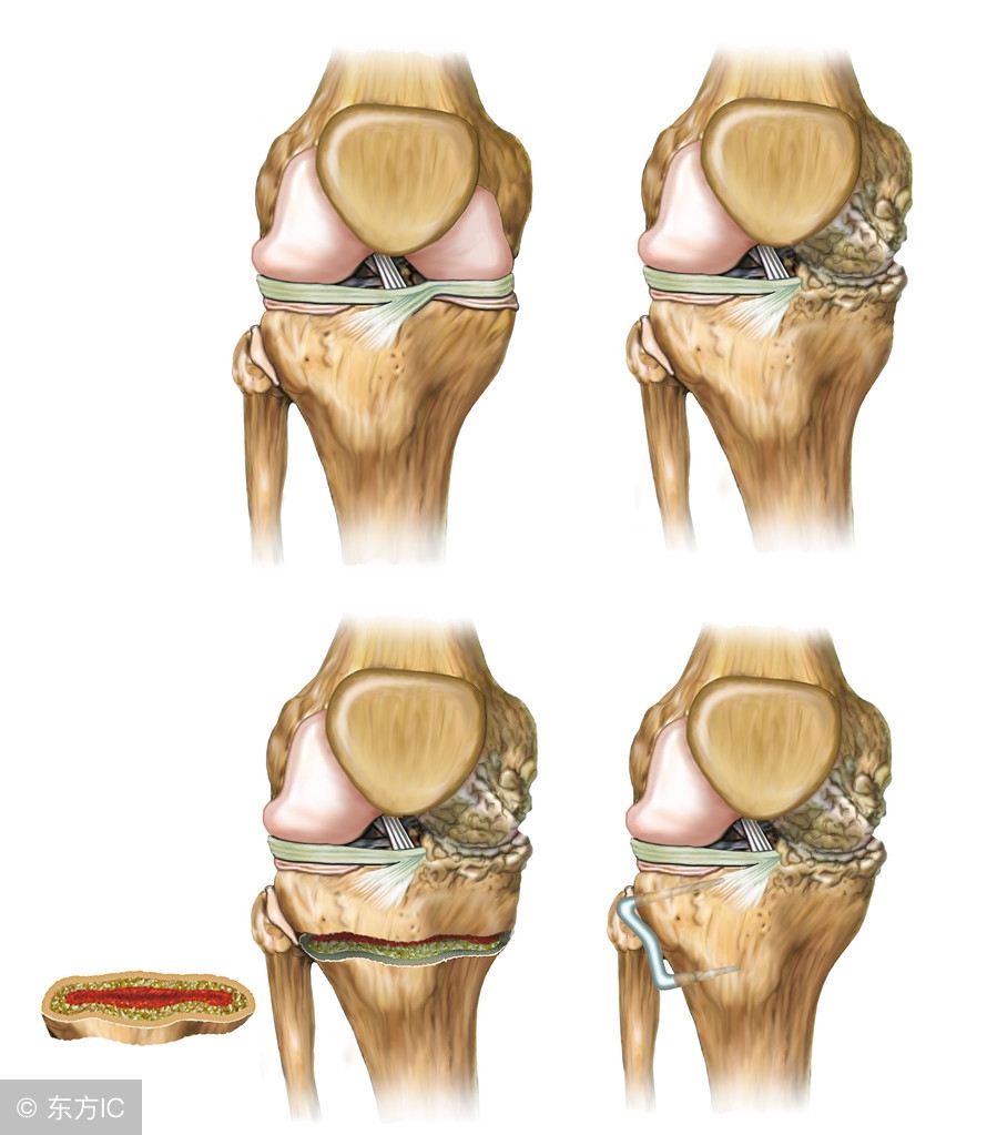 风湿性骨关节炎,骨关节炎与类风湿关节炎哪个严重