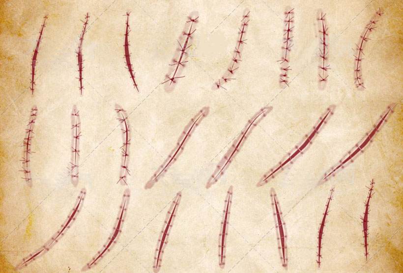 不需拆线的伤口几天可以洗澡,背部伤口拆线后多久可以洗澡