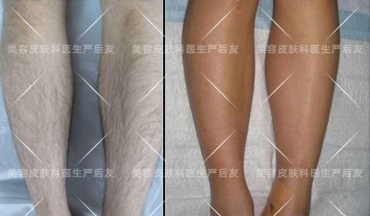 上海面部激光脱毛,日本全身激光脱毛