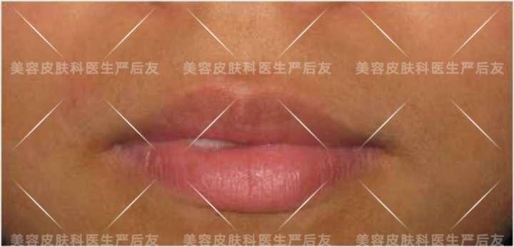 上海面部激光脱毛,日本全身激光脱毛