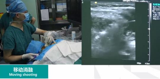 微波消融术，让甲状腺患者康复“加速度”