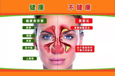 慢性鼻炎的最佳食疗,慢性鼻炎偏方简直太神了