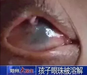 二十分钟孩子的眼球被溶解,孩子眼球被融化的东西很常见