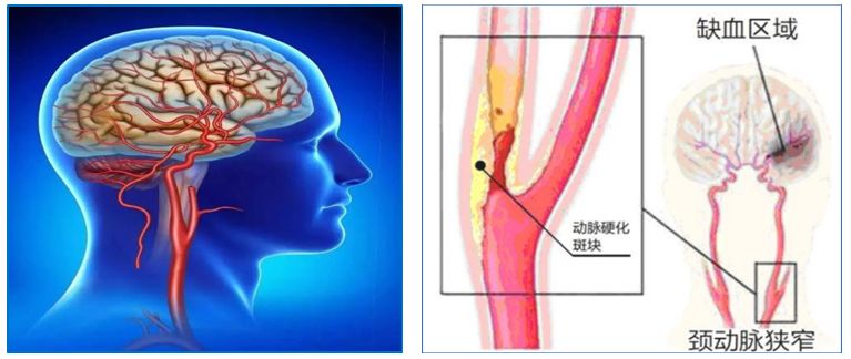 颈动脉脑血栓,颈动脉堵塞造成脑梗怎么预防