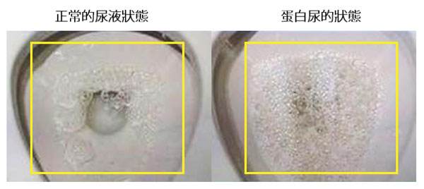 小孩尿很臭是不是生病？家长你会看尿识病吗？