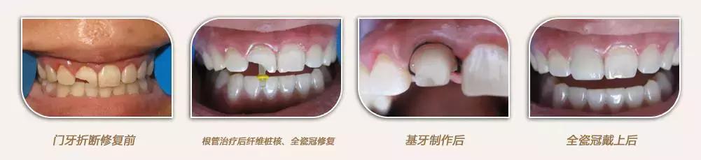 下牙缺失导致舌头变大,口腔牙列缺失患者情况