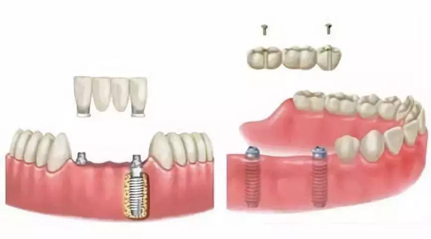 下牙缺失导致舌头变大,口腔牙列缺失患者情况