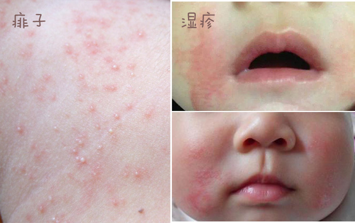 婴儿肌肤总有问题,远离宝宝肌肤问题