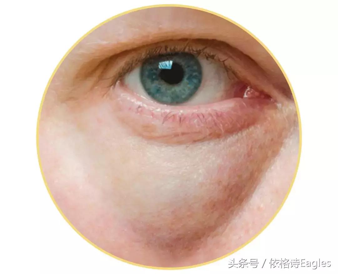 怎么去除黑眼圈和细纹,黑眼圈细纹还有得救吗