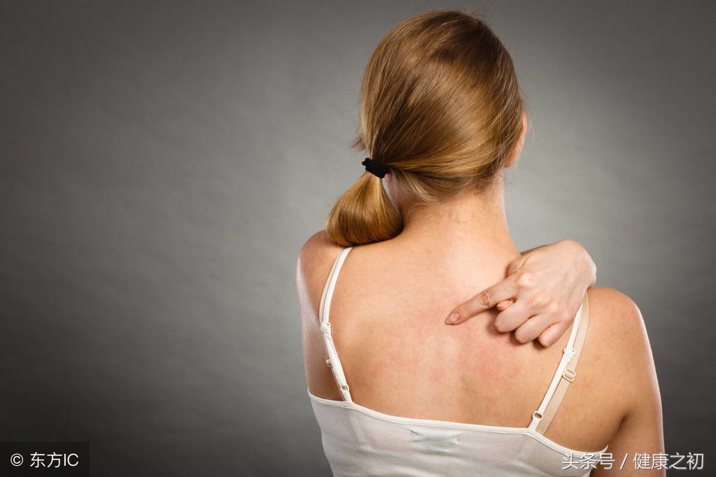 关于慢性荨麻疹治疗原则是什么,慢性荨麻疹吃什么中药