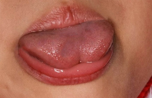 孩子舌筋过短怎么办,舌筋过短