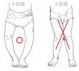 x型腿腿不直怎么办,x型腿o型腿的原因