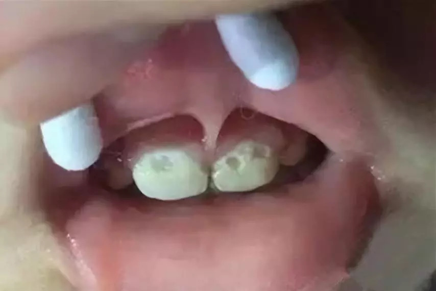 2岁宝宝牙齿全烂光，这5个问题不及时处理，孩子将来恨你一辈子