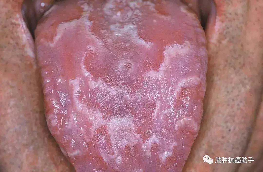 舌头上有白斑是癌症的前兆,舌头边缘出现小黑斑是不是癌症