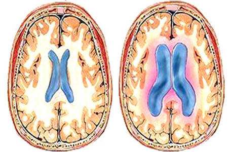 脑积水的治疗,脑积水的治疗与护理ppt