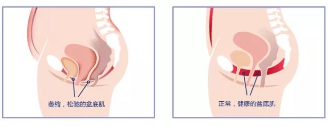 产后哪都瘦了，唯独这里不瘦