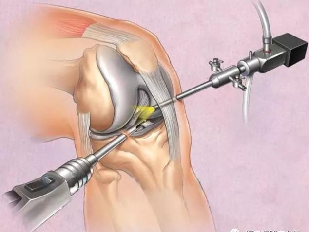 膝盖做关节镜手术多久能恢复,痛风关节镜手术多久可以恢复