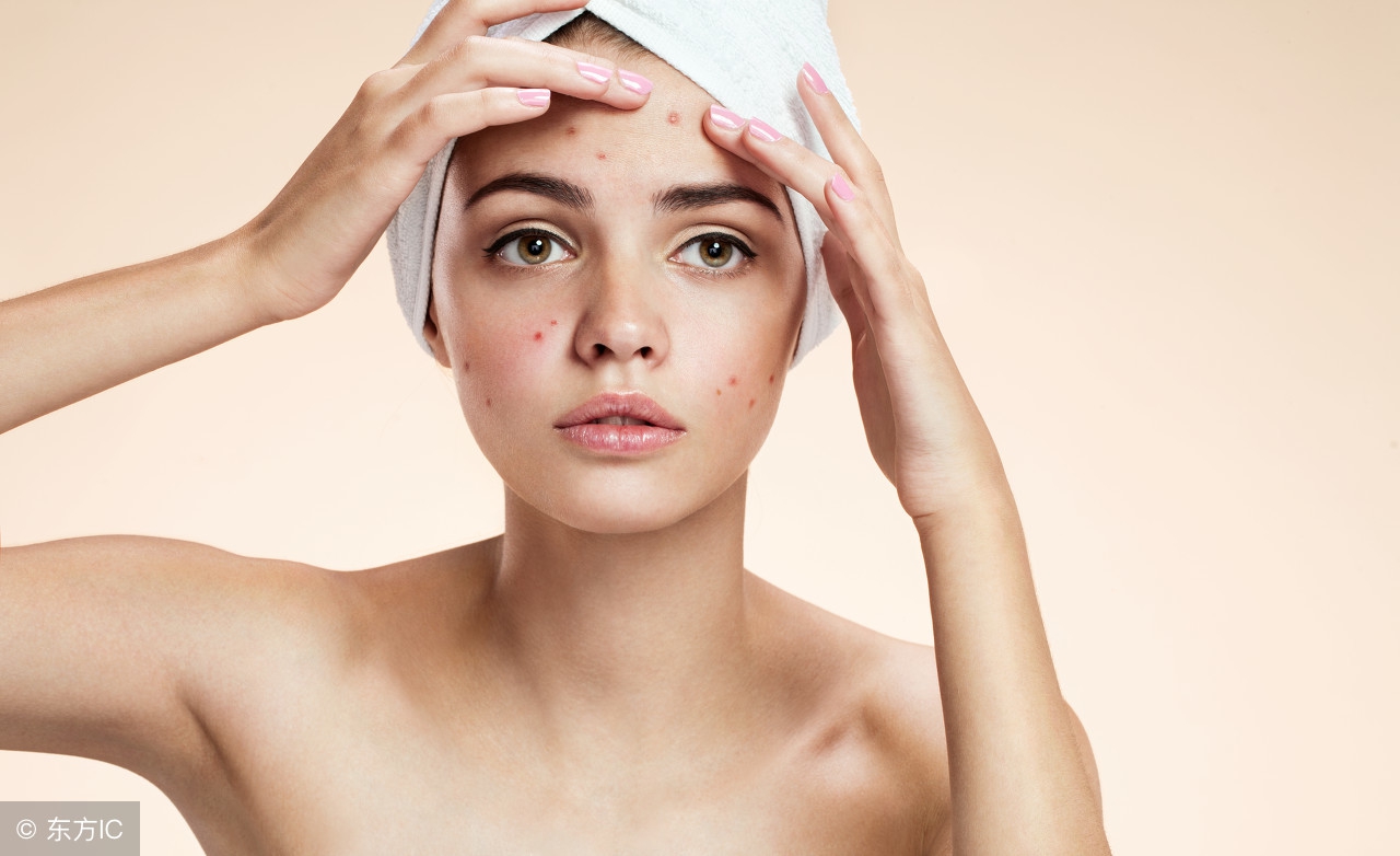 “避孕药”也能治痘痘？医生说：除了它，这几种药物你也想不到！