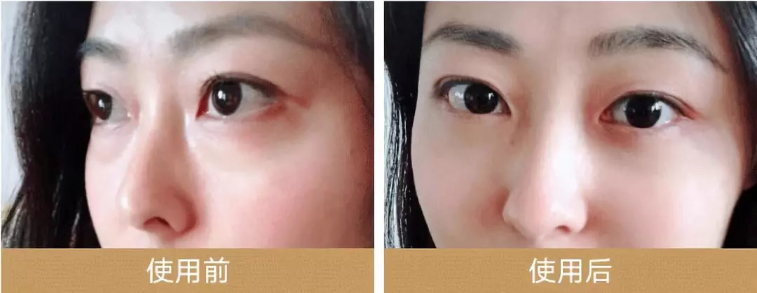 外用中药眼膜,中药眼膜去眼袋眼纹