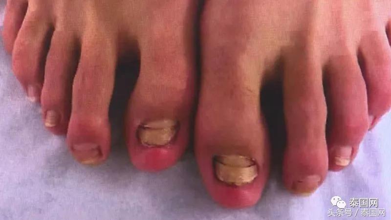 火遍全泰的这种“小鱼啃脚Spa”,你可知有多大健康风险?