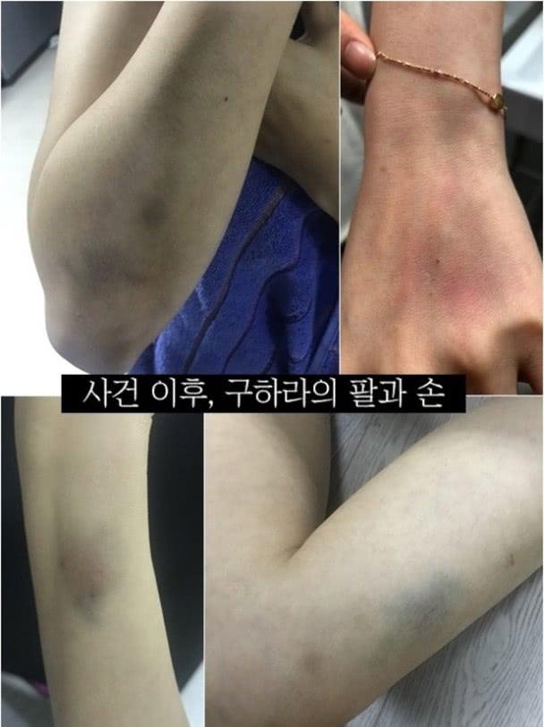 韩国女星被男友打到子宫出血，男方还坚持是女友对他施暴