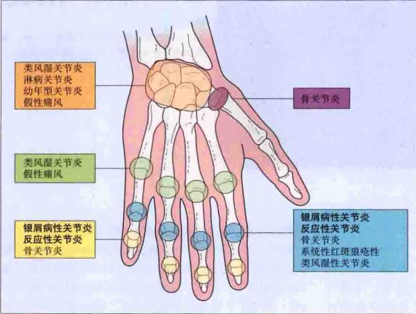 世界银屑病日银屑病关节炎,银屑病关节炎是银屑病后期吗