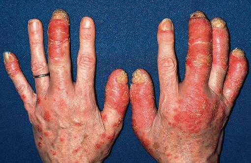 世界银屑病日银屑病关节炎,银屑病关节炎是银屑病后期吗