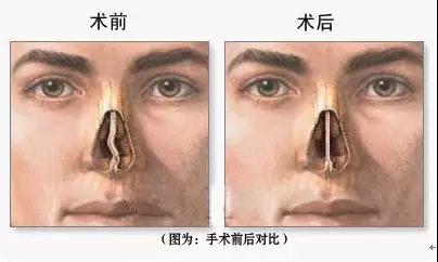鼻中隔偏曲需要手术治疗吗,鼻中隔偏曲手术引起空鼻症