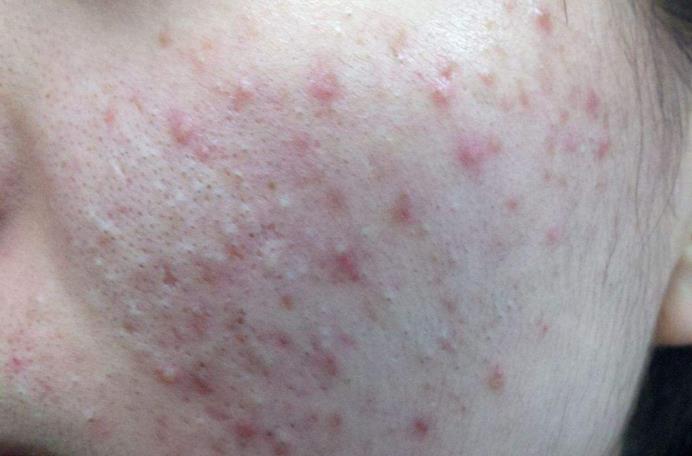 床上螨虫多皮肤会有很多痘痘吗,床上的螨虫到底有多少