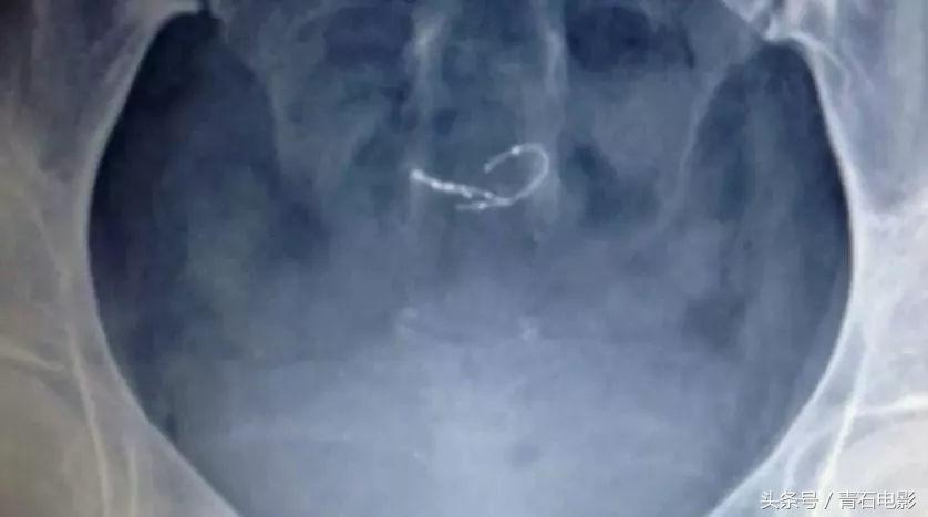 4公分线圈可避孕，护士曾为其代言，但纪录片上映后产品遭停售！