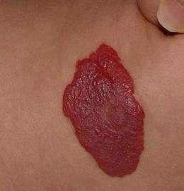 血管畸形治疗方法有哪些？会带来什么样的后果！