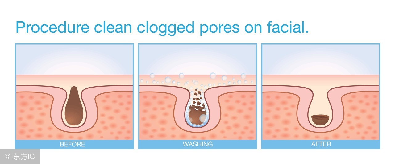 男生后背经常长痘痘,男生后背长痘如何消除
