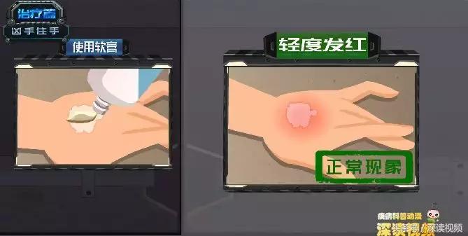 激光治疗和皮肤移植哪家强？治疗白癜风，最新黑科技大盘点