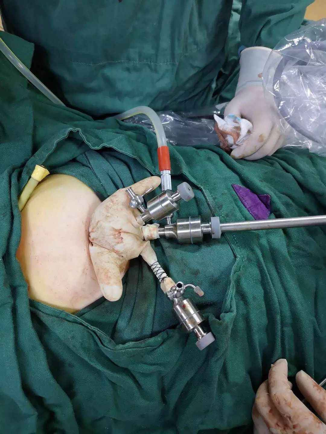 好“腔”法！泉州福兴妇产医院成功开展妇科单孔腹腔镜手术，创伤小无疤痕