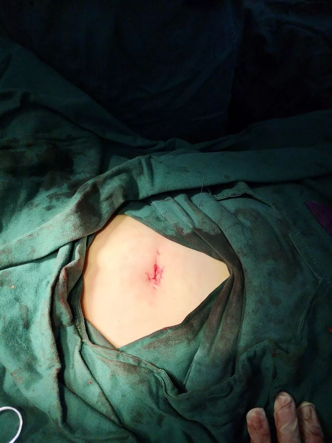 好“腔”法！泉州福兴妇产医院成功开展妇科单孔腹腔镜手术，创伤小无疤痕