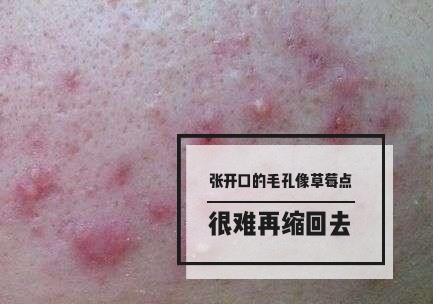 最可怕的痘痘,痘痘不可怕泛红才可怕