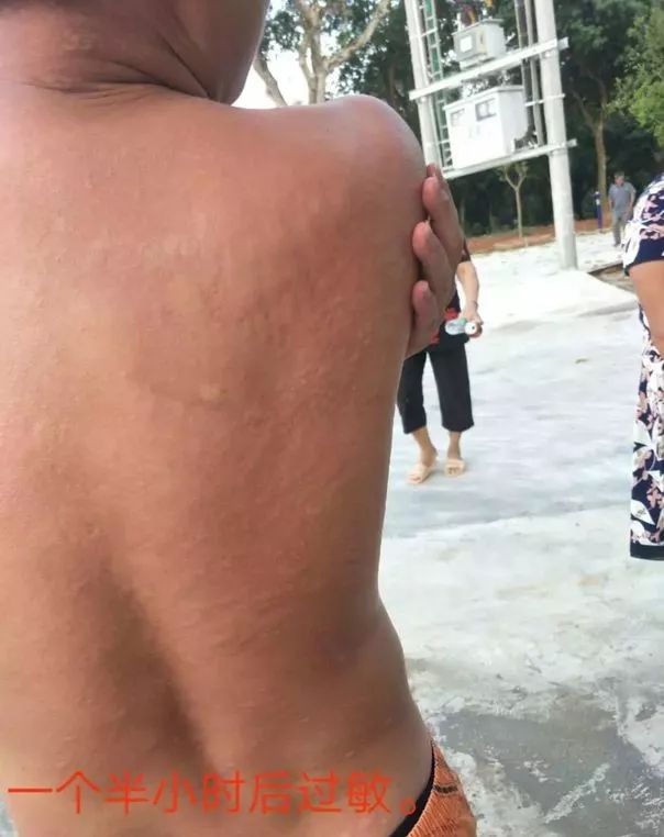 广西蚂蚁咬人事件,广西有种蚂蚁被咬全身痒